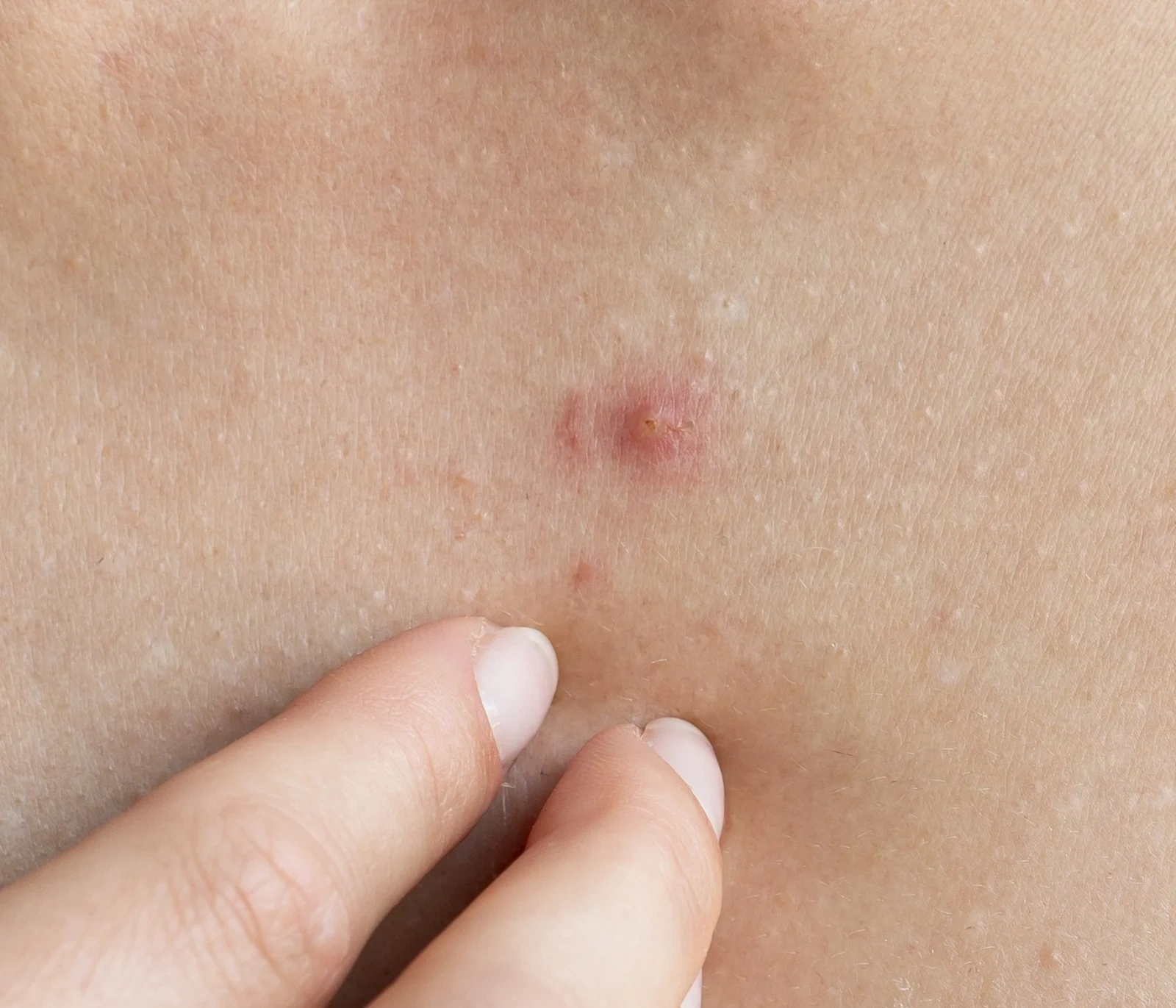 infected-skin-bites-1-scaled