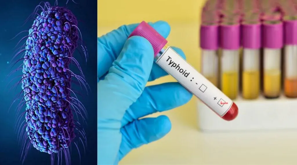 Typhoid Vaccine for International Travelers